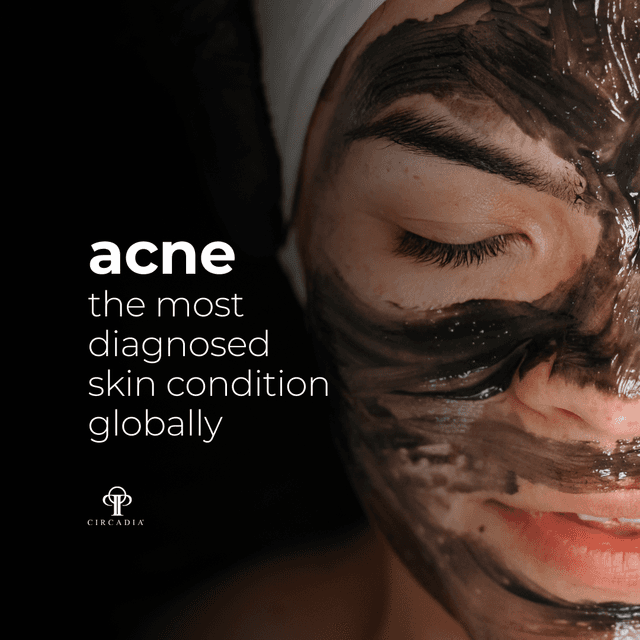 Acne Bootcamp at Worthy Beauty in Midland, MI